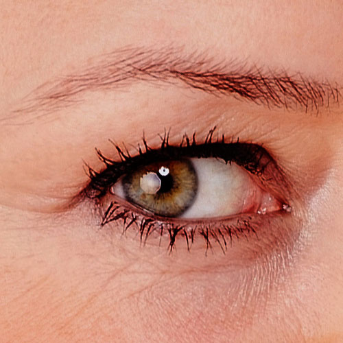 Oculoplastia tratamiento clinica oftalmológica de ojos en Tarragona